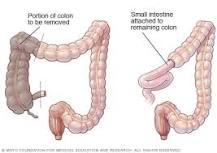 Image result for icd 9 code for hemicolectomy
