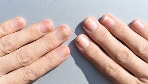 nail psoriasis the chelsea clinic