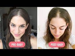 extreme hair loss after pregnancy