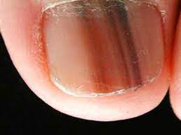 the black line on nail is it splinter