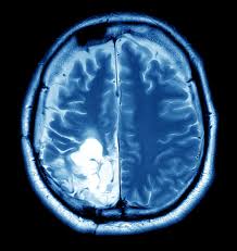 Brain Tumor Overview Harvard Health