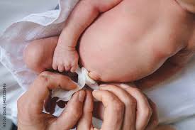 bandage of newborn baby neonatal care