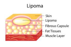 lipomas vs liposarcoma what s the