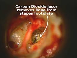 Itchiness or tickling inside the ear. Otosclerosis Tampa Bay Hearing