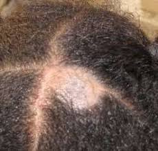 Hair infection by fungal agents is scientifically known as trichomycosis. Fungal Scalp Infection Scalp Ringworm Diagnosis And Treatmnet Patient
