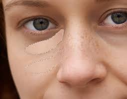 how to remove dark circles under the