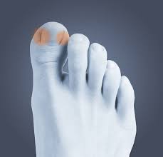 ingrown toenail treatment relief dr