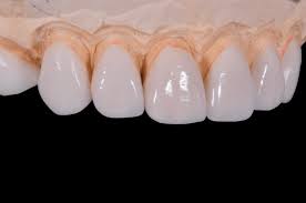 Lots of people, who have problems with their teeth, want to find ways to improve them. What Are Diy Veneers And How Do They Work The Teeth Blog