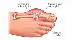 Our website is an online myfruits pt forum site. Topic Gout Pain Finally Gone But Swelling Persists Goutpal Gout Forum