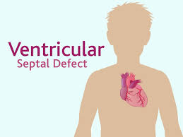 Ventricular Septal Defect For Teens Nemours Kidshealth