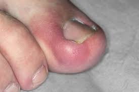 check if you have an ingrown toenail