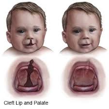 cleft lip and cleft palate repair