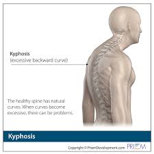 It affects less than one percent of the population and occurs mostly in children between the ages of 10. Kyphosis Spine Group Orlando
