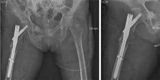 proximal femur osteomyelitis occurred