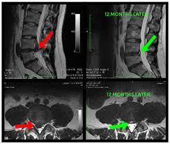 can lumbar disc protrusions heal on