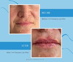lip fillers before and after 1 ml