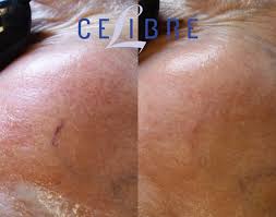 spider vein removal before and after