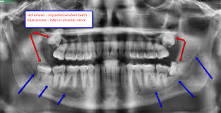 wisdom teeth nerve damage north texas