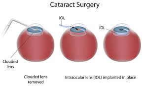 cataracts surgery orange harvard eye