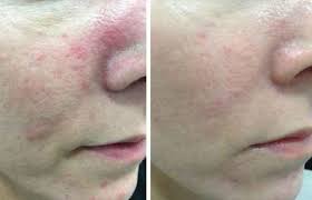 ipl for rosacea everything you should