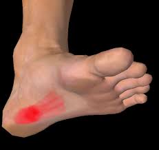 heel pain when running matthew boyd
