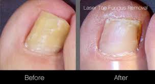 laser toe fungus removal in toronto