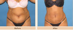 weight after liposuction