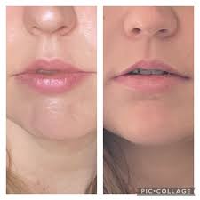 restoring volume to lips after jaw