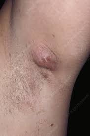 hidradenitis suppurativa of the armpit
