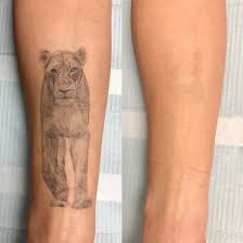laser tattoo removal vancouver