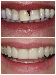 Along with front teeth gap filling, the braces treatment also helps to make the teeth alignment in symmetrical order. Gap In Teeth Treatment Advanced Dentistry