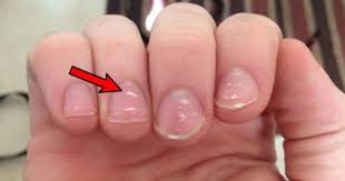 what causes white marks on our nails