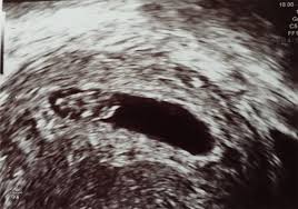 Der bauchumfang der mama und weitere veränderungen 9. Ultraschallbilder Mehr Als 50 Bilder Aus Der Schwangerschaft Faminino