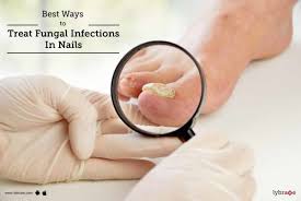 treat fungal infections in nails