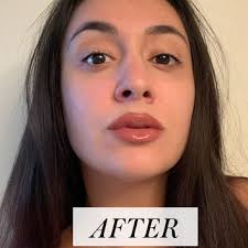 lip fillers beauty photos trends