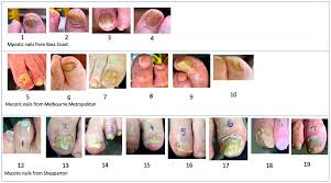 meenomics of toenail onychomycosis