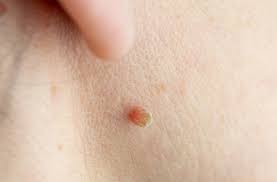 Can you safely remove skin tag yourself at home?  Illuminate Skin Clinics