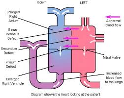 Atrial Septal Defect Asd Downs Heart Group