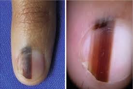 dermoscopy of the nail plate nail