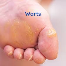 warts cleveland foot and ankle