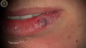 hemangioma on lower lip with laser