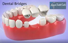 dental bridges types cost advantages