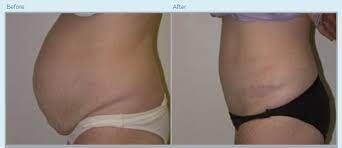tummy tuck middletown nj red bank