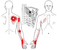 myofascial trigger point therapy