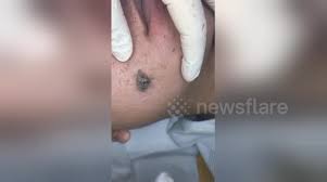 But just because it could be effective doesn't mean it's necessarily worth trying. Newsflare Dermatologist Removes Massive Blackhead From Patient S Face