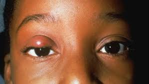 styes and chalazion south bay