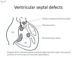 Ventricular Septal Defects Ppt Video Online Download