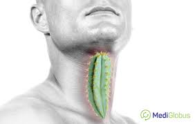 Sometimes, it can cause a palpable lump to form in the neck, although this symptom. Throat Cancer Surgery Mediglobus