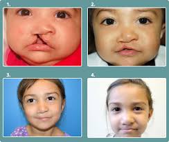 before after cleft lip palate