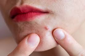 nodular acne symptoms causes and how